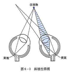 6-2斜视性弱视.PNG